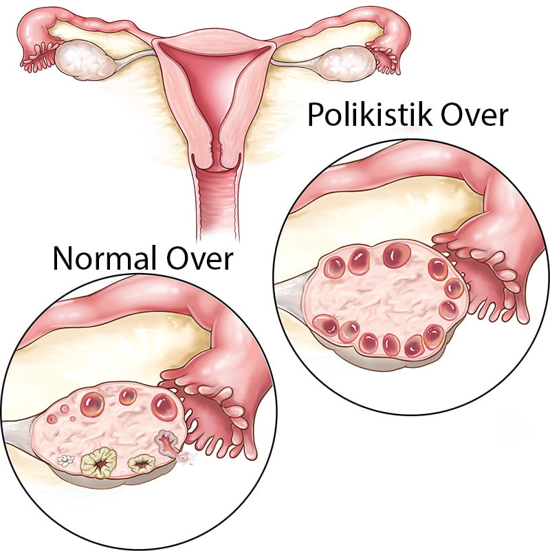 polikistik over sendromu